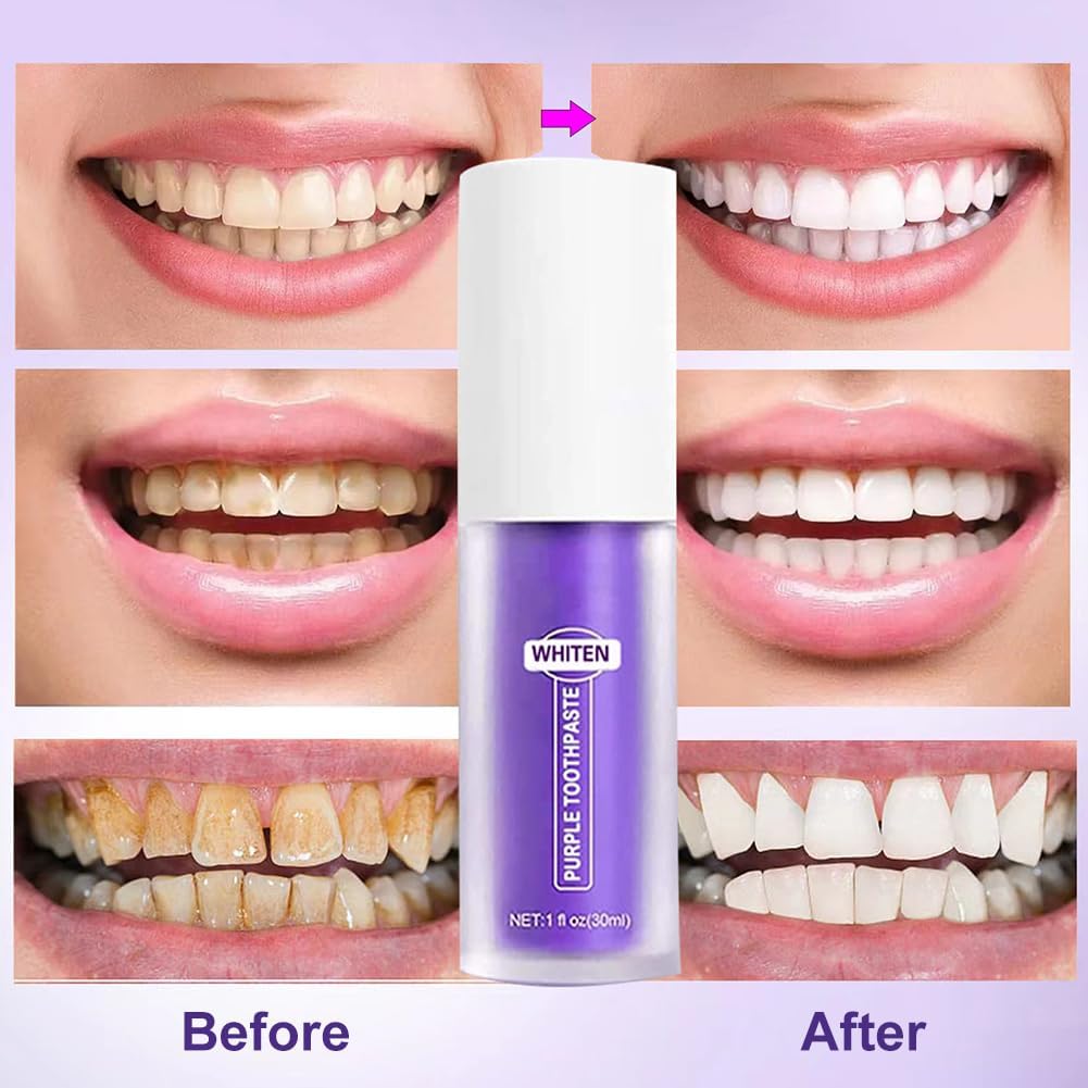 Dentifrice Blanchissant Violet,Blanchiment Dentaire Violet,Dents Blanches Violets,Dentifrice Blanchissant,Purple Teeth Whitening,Purple Toothpaste,Blanchiment Des Dents